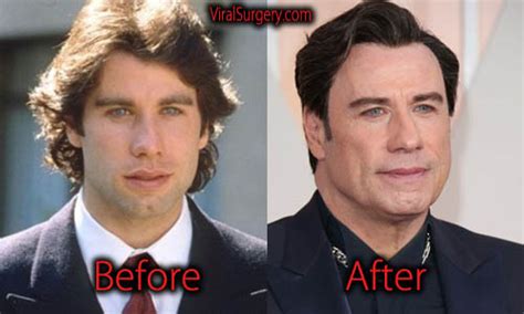 John Travolta Plastic Surgery: Before and After His Botox and。